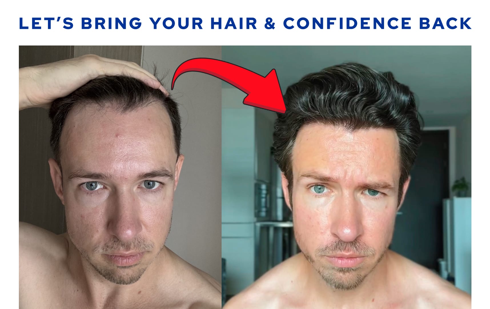 Hair Transplant Guidance Call