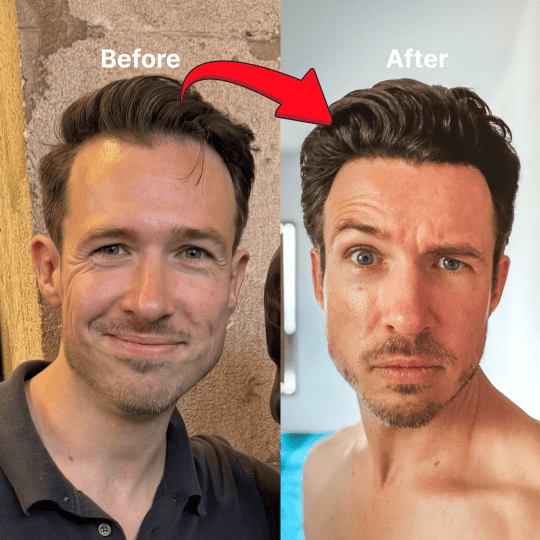 Ben's before and after hair transplant result